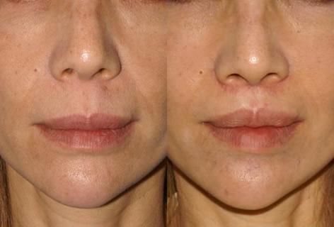 Lip Lifting: a solução para o envelhecimento dos lábios