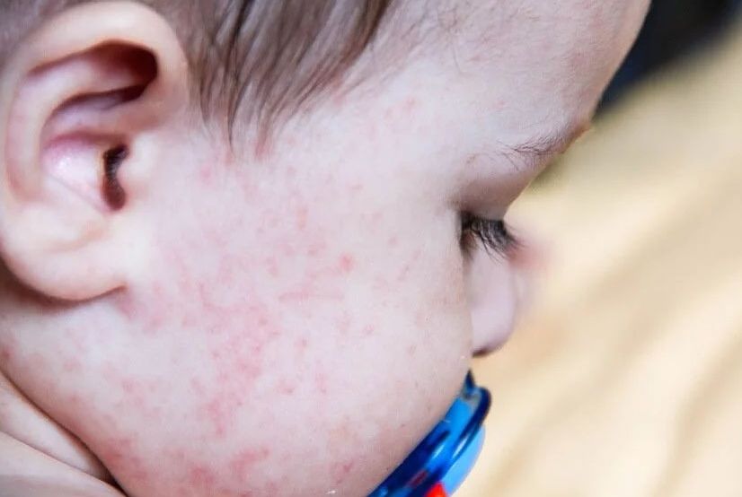 Alergia alimentar: crianças são as maiores atingidas