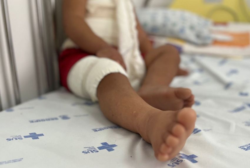 Huse divulga balanço de casos de acidentes de trânsito e queimados no mês de junho